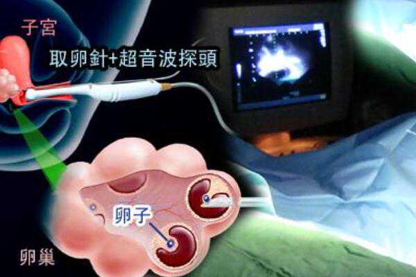 杭州当地哪个医院试管婴儿成功率最高？,杭州市试管婴儿成功率最高的医院是